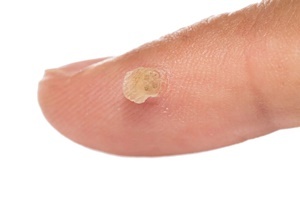 A wart is a skin disease that effectively fights Skincell Pro