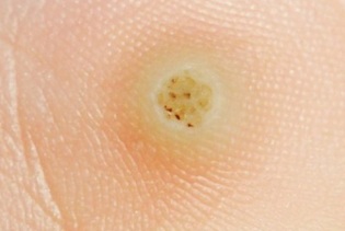 What does a plantar wart look like