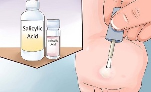 how to get rid of papillomas using folk remedies
