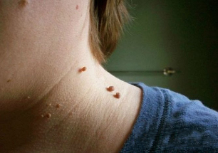 papillomas in the neck