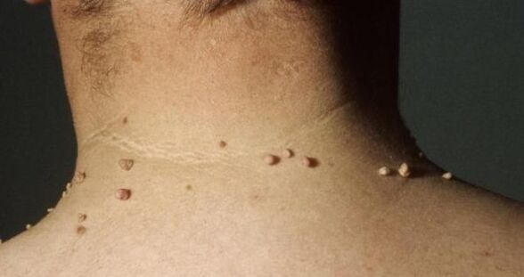 small papillomas in the neck