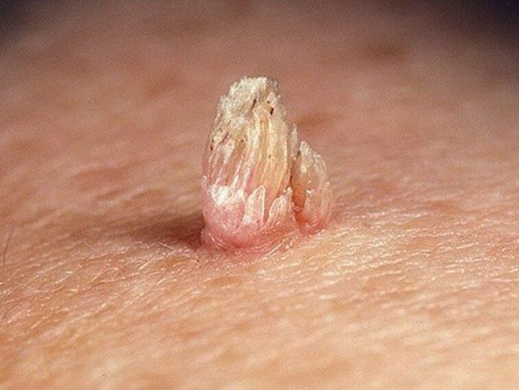 genital papilloma in the body