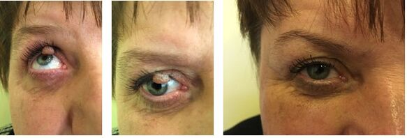 removal of papillomas on the eyelid
