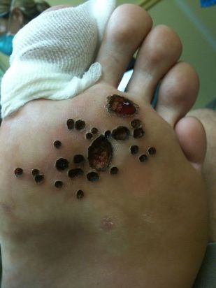 Skin after laser removal of warts on the legs