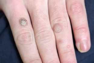 Warts on the hands