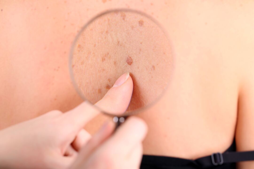 Skin papilloma that can be removed at home